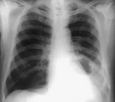 Radiograph from the case bank: Lung abscess