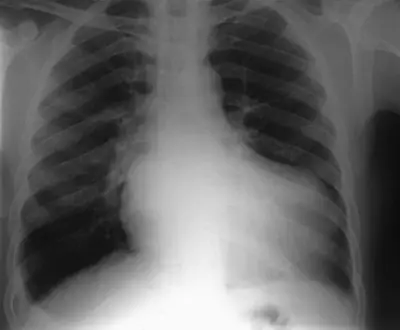 Radiograph from the case bank: Cardiomegaly