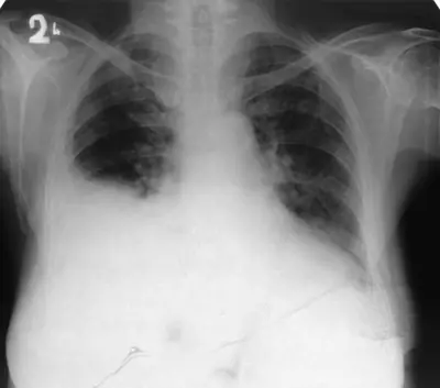 Radiograph from the case bank: Pleural effusion
