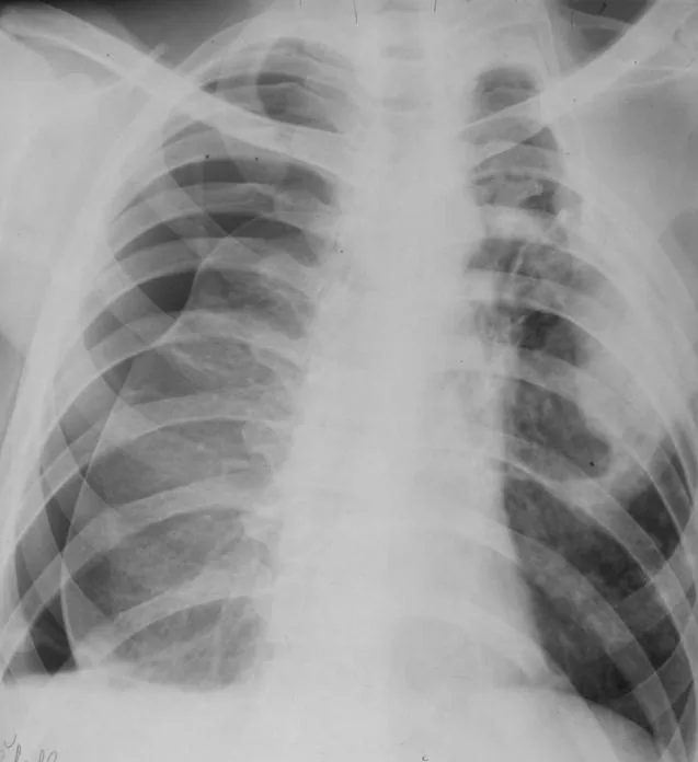 Chest radiograph for self-assessment
