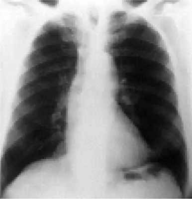 Radiograph from the case bank: Normal chest radiograph