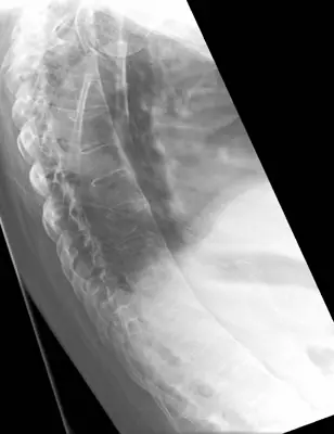Radiograph from the case bank: Ankylosing spondylitis
