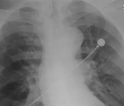 Radiograph from the case bank: Endotracheal tube
