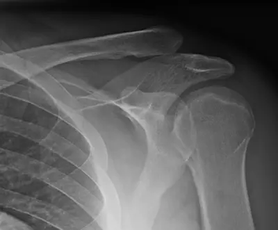 Radiograph from the case bank: Acromioclavicular joint dislocation