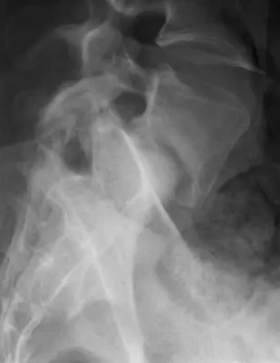 Radiograph from the case bank: Spondylolisthesis
