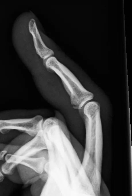 Upper limb radiograph for self-assessment