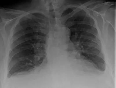 Radiograph from the case bank: Pulmonary oedema (heart failure)