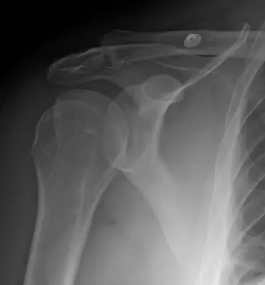 Radiograph from the case bank: Hill-Sachs lesion