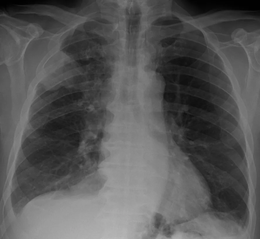 Chest radiograph for self-assessment