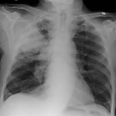 Radiograph from the case bank: Lung cancer (mass)
