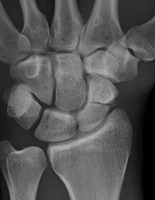 Radiograph from the case bank: Scaphoid fracture