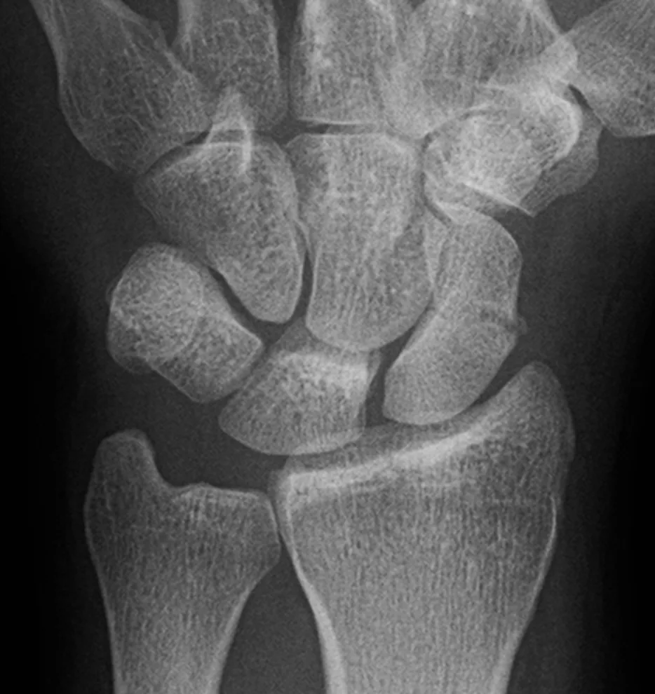 Upper limb radiograph for self-assessment