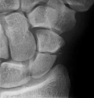 Radiograph from the case bank: Scaphoid fracture