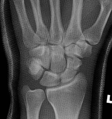 Radiograph from the case bank: Scaphoid fracture