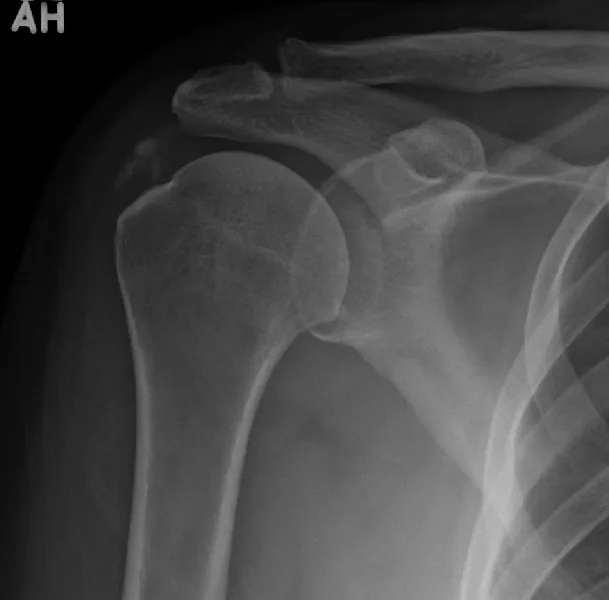 Upper limb radiograph for self-assessment