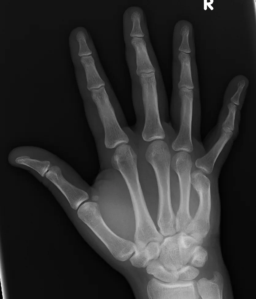 Upper limb radiograph for self-assessment