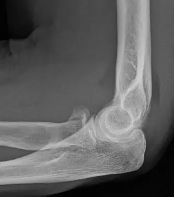 Radiograph from the case bank: Radial head fracture