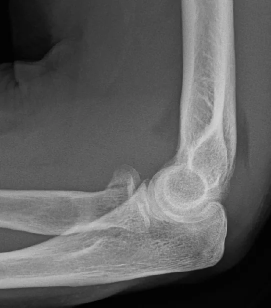 Upper limb radiograph for self-assessment