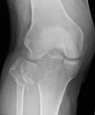 Radiograph from the case bank: Tibial plateau fracture