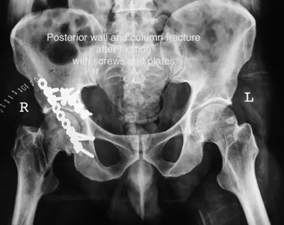 Radiograph from the case bank: Acetabular fracture