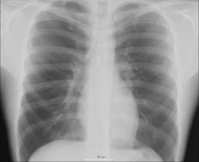 Radiograph from the case bank: Normal chest radiograph