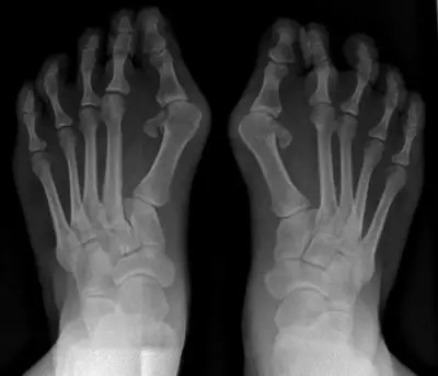 Radiograph from the case bank: Hallux valgus (bunion)