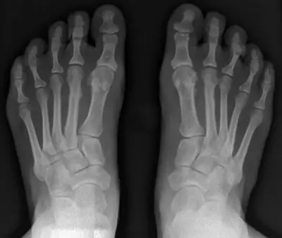 Radiograph from the case bank: Hallux valgus (bunion)
