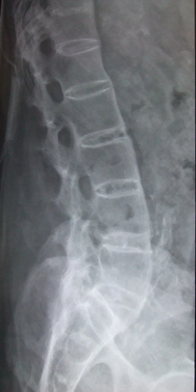Spine radiograph for self-assessment