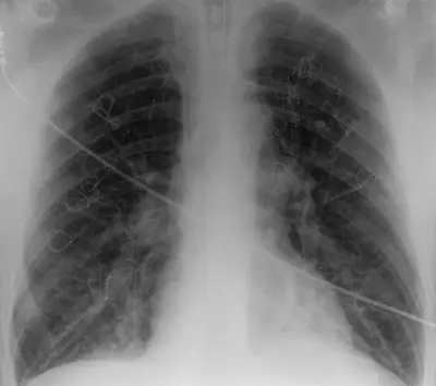 Radiograph from the case bank: Emphysema / COPD (hyperinflation)