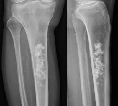 Radiograph from the case bank: Enchondroma