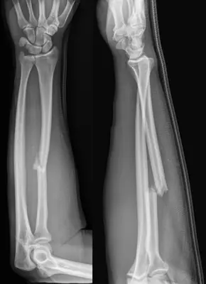 Radiograph from the case bank: Galeazzi fracture-dislocation