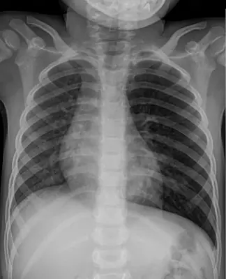 Radiograph from the case bank: Inhaled (aspirated) foreign body