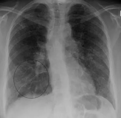 Radiograph from the case bank: Sarcoidosis