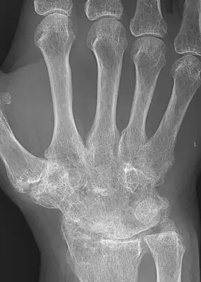 Radiograph from the case bank: Rheumatoid arthritis