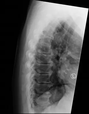 Radiograph from the case bank: Diffuse idiopathic skeletal hyperostosis (DISH)