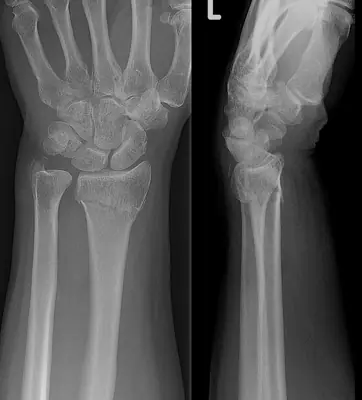 Radiograph from the case bank: Distal radius fracture