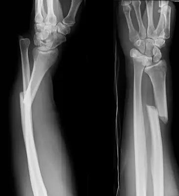 Radiograph from the case bank: Galeazzi fracture-dislocation