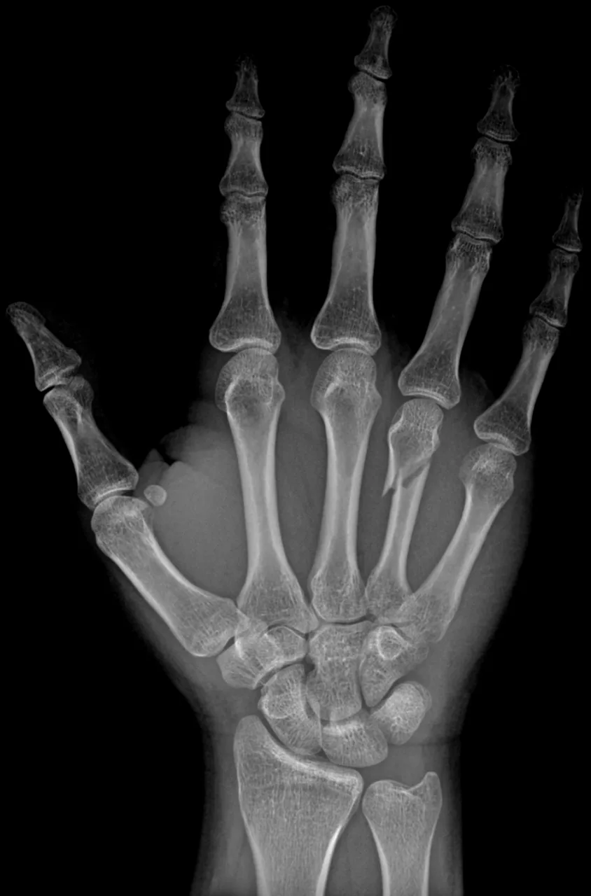 Upper limb radiograph for self-assessment