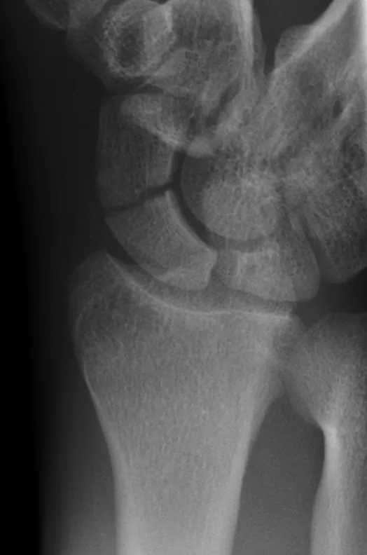 Upper limb radiograph for self-assessment