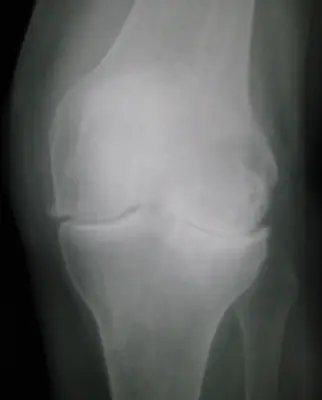 Radiograph from the case bank: Knee osteoarthritis
