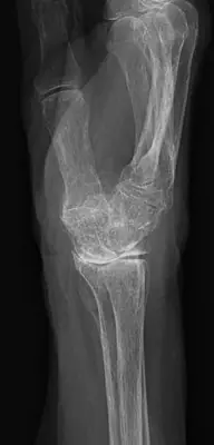 Radiograph from the case bank: Osteoarthritis