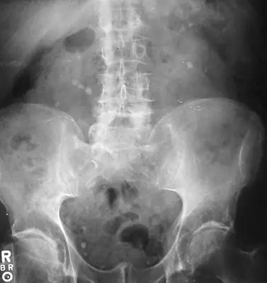 Radiograph from the case bank: Urinary tract calculi (kidney or ureteric stones)