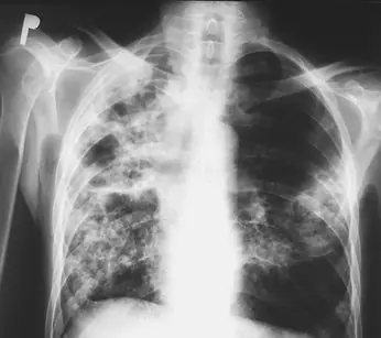 Radiograph from the case bank: Pulmonary tuberculosis