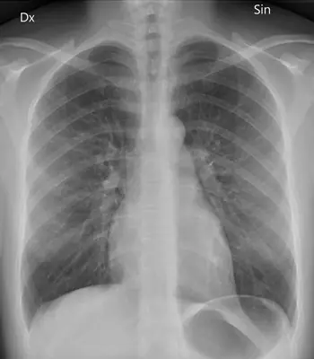 Radiograph from the case bank: Normal chest radiograph