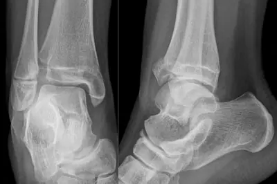 Radiograph from the case bank: Tibial (and fibular) shaft fracture