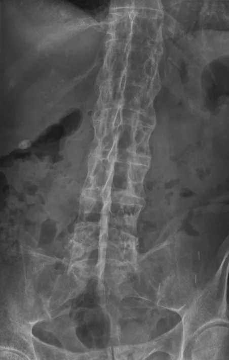 Spine radiograph for self-assessment