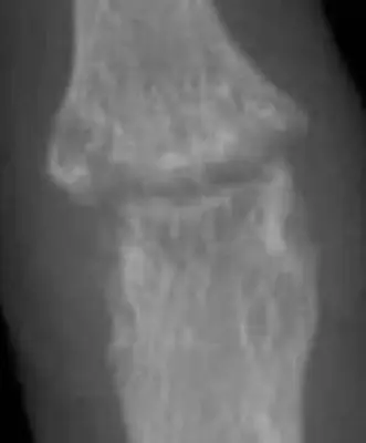 Radiograph from the case bank: Rheumatoid arthritis