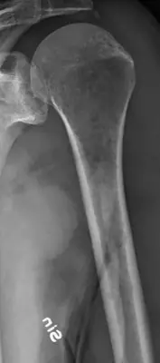 Radiograph from the case bank: Multiple myeloma