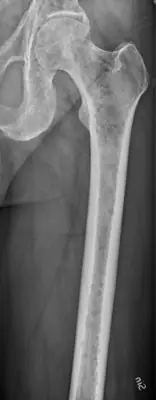 Radiograph from the case bank: Multiple myeloma