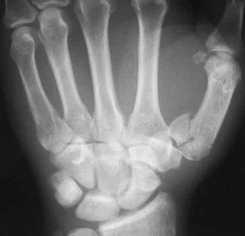 Upper limb radiograph for self-assessment